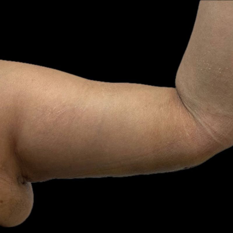 شد الذراعين 2-2