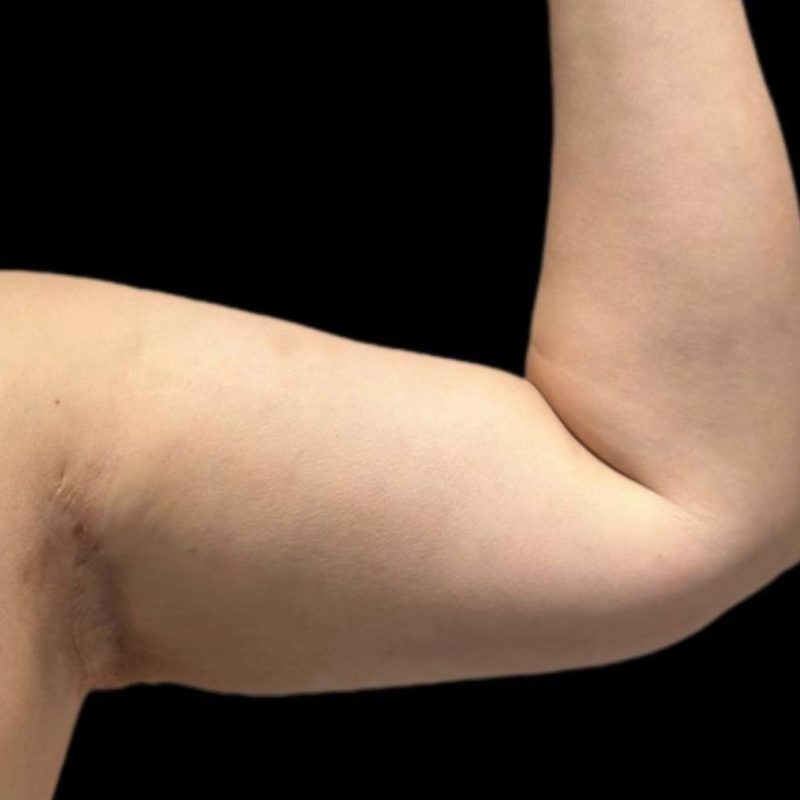 شد الذراعين 3-1