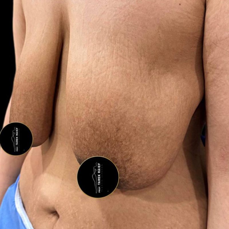 شد و رفع الثدي 1-1