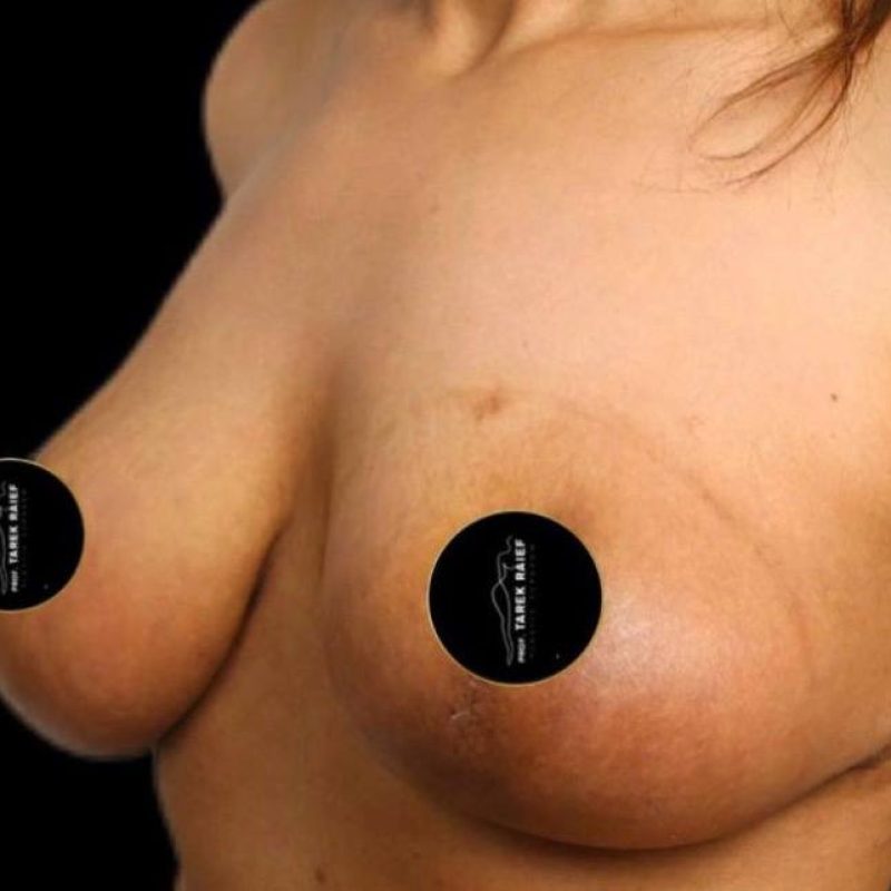 شد و رفع الثدي 1-2