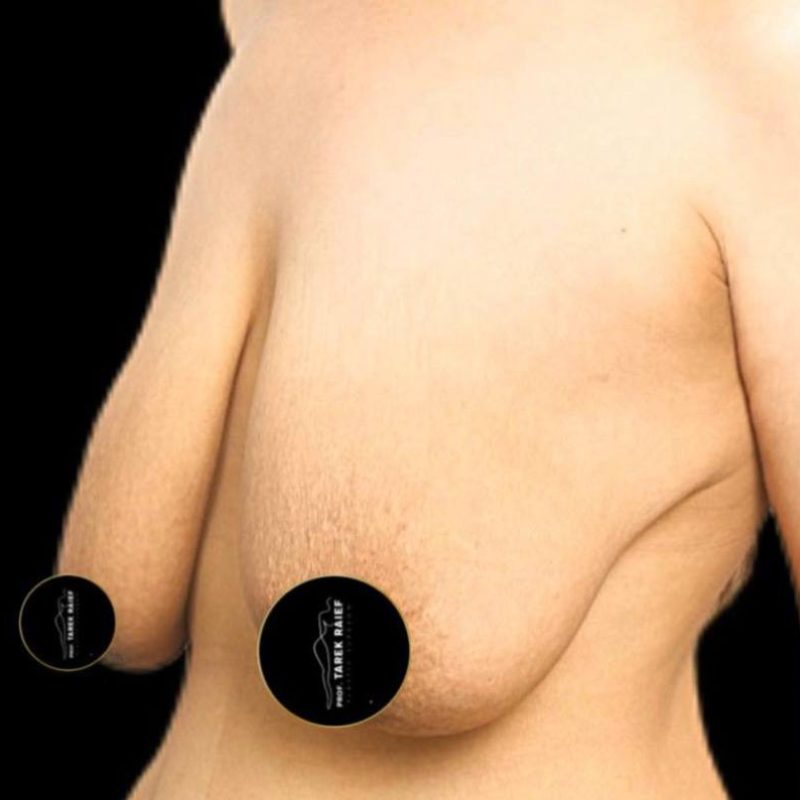 شد و رفع الثدي 2-1