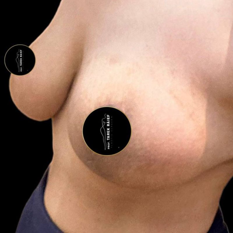 شد و رفع الثدي 2-2