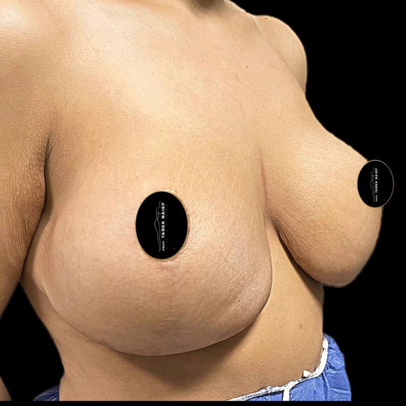 شد و رفع الثدي 3-1