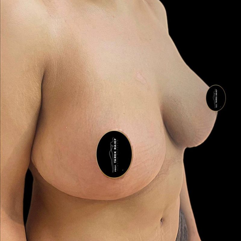 شد و رفع الثدي 3-2