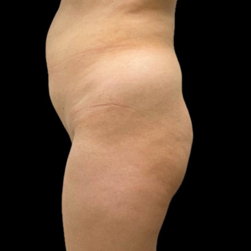 شفط الدهون 2-1