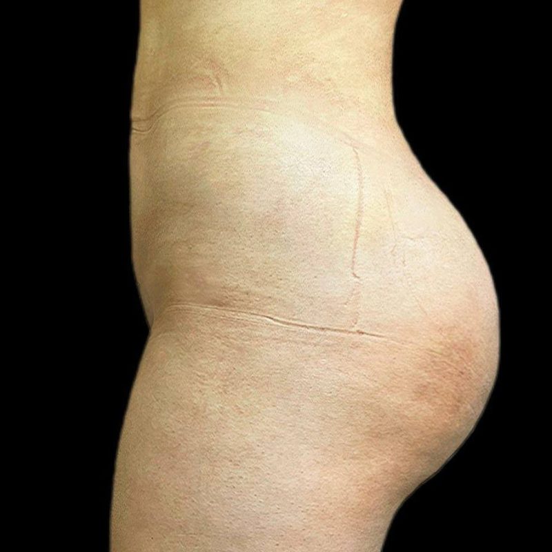 شفط الدهون 2-2