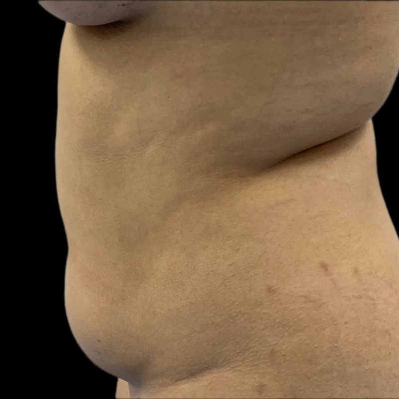 شفط الدهون 3-1