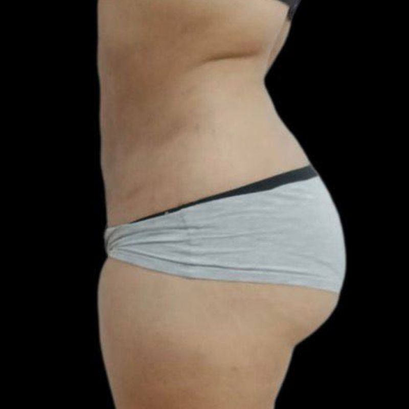 شفط الدهون 3-2