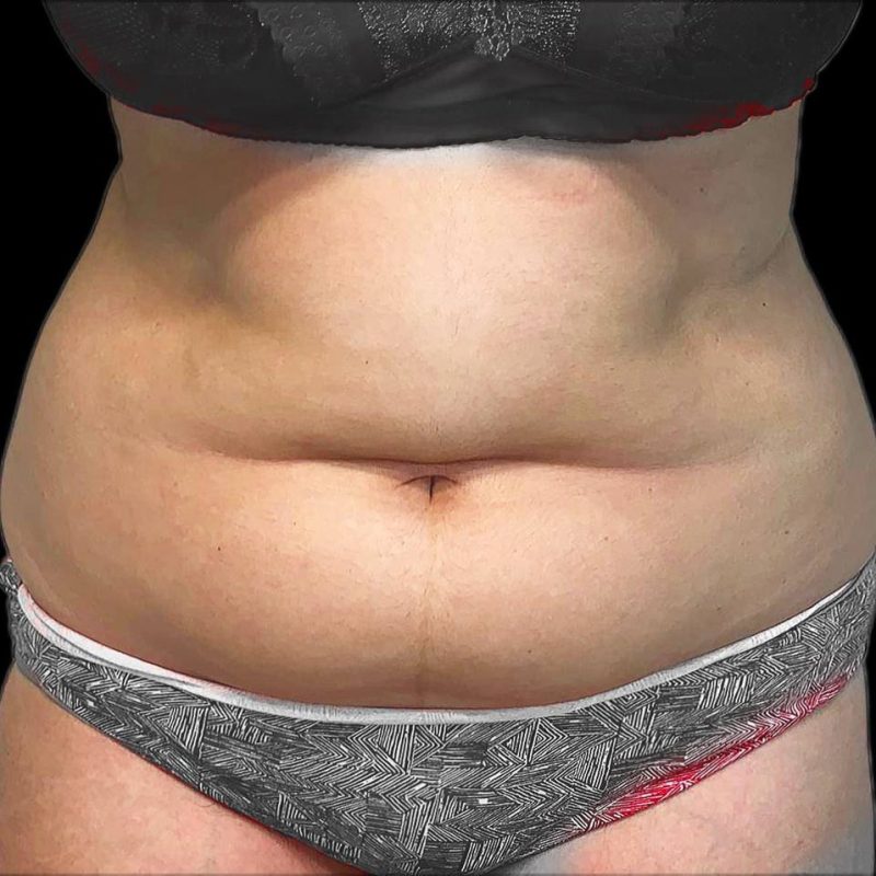 شفط الدهون 4-1