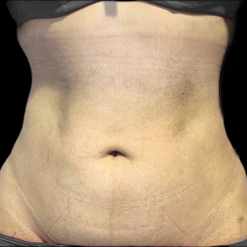 شفط الدهون 4-2