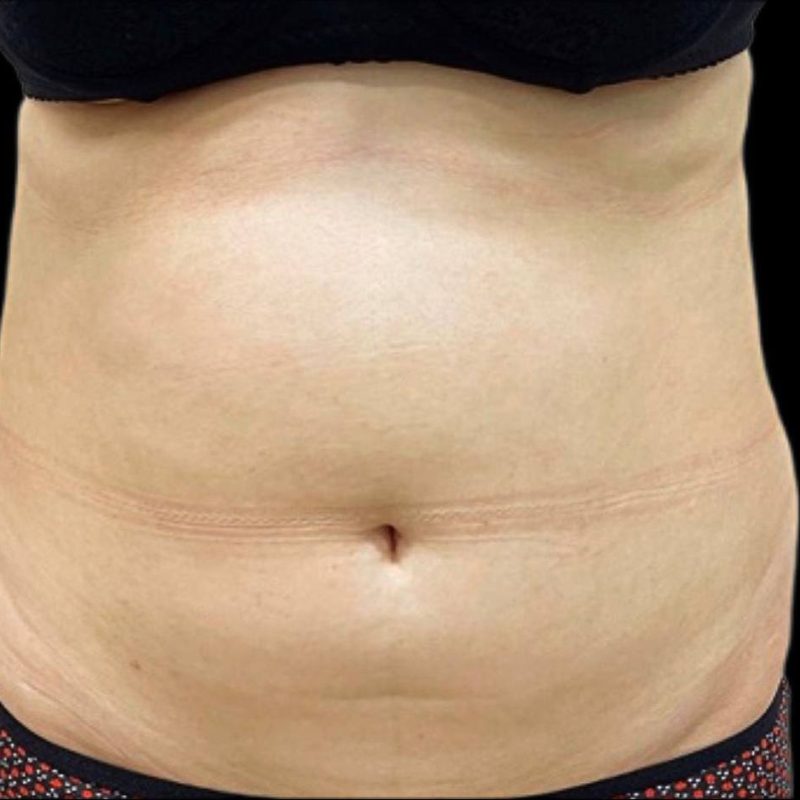 نحت الجسم شفط الدهون 1-1