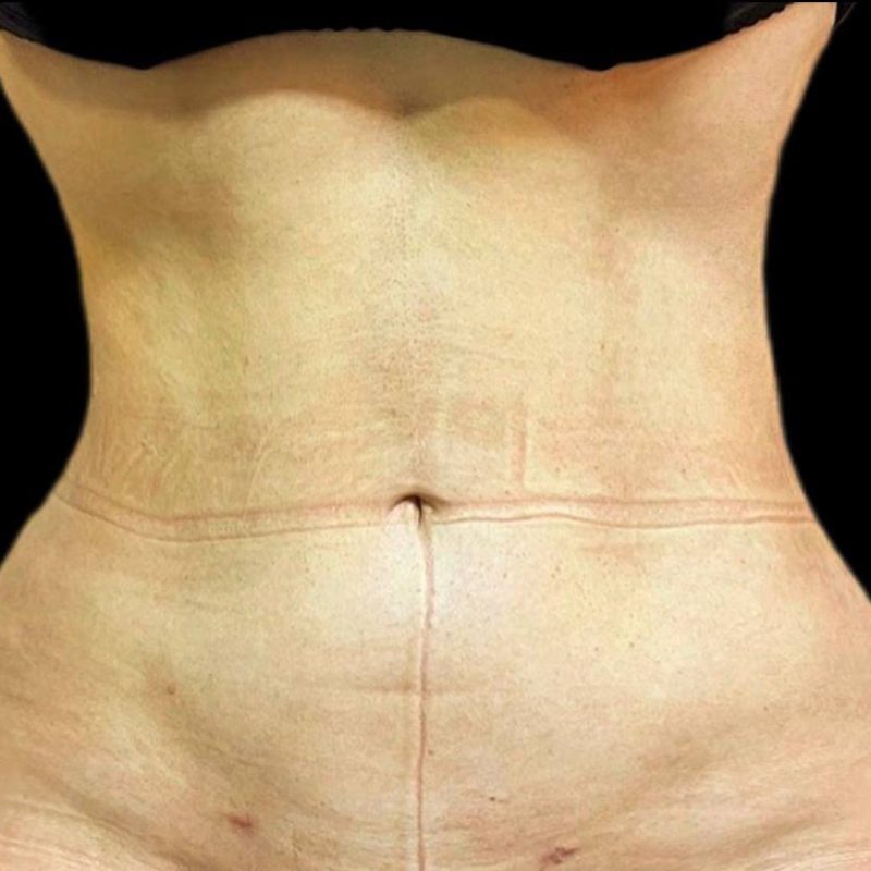 نحت الجسم شفط الدهون 1-2