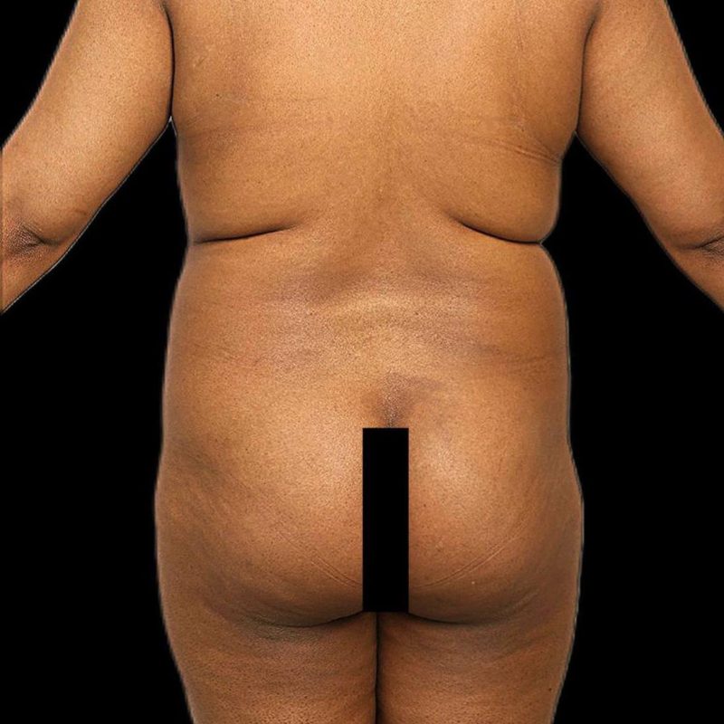 نحت الجسم شفط الدهون 2-1