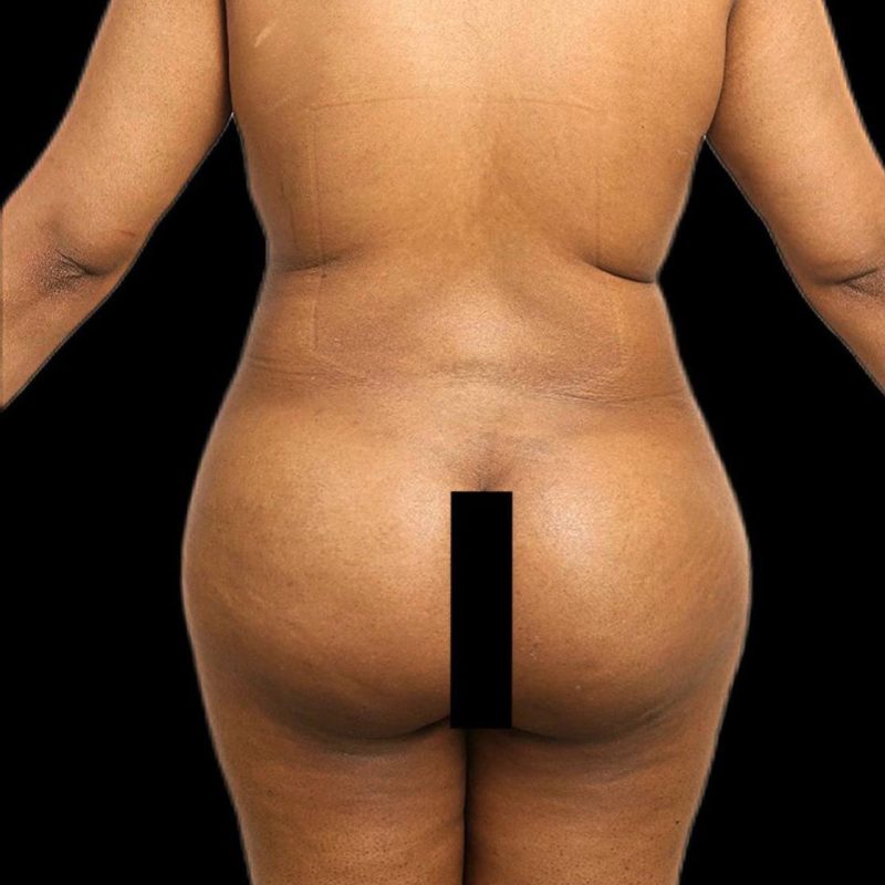 نحت الجسم شفط الدهون 2-2