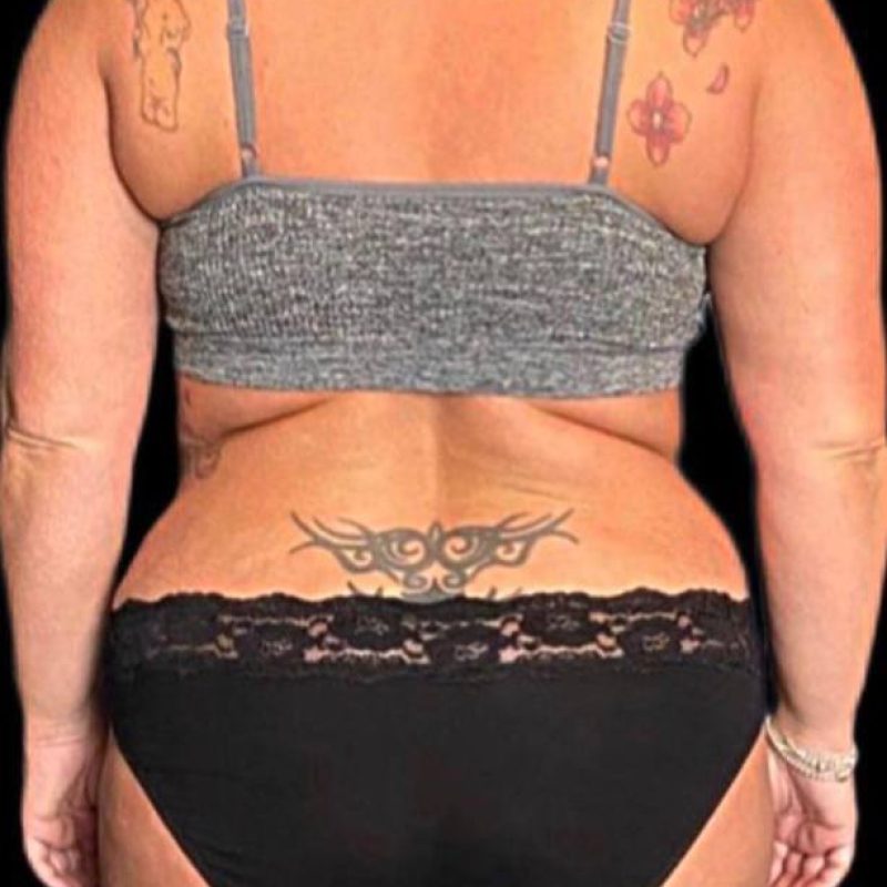 نحت الجسم شفط الدهون 3-1