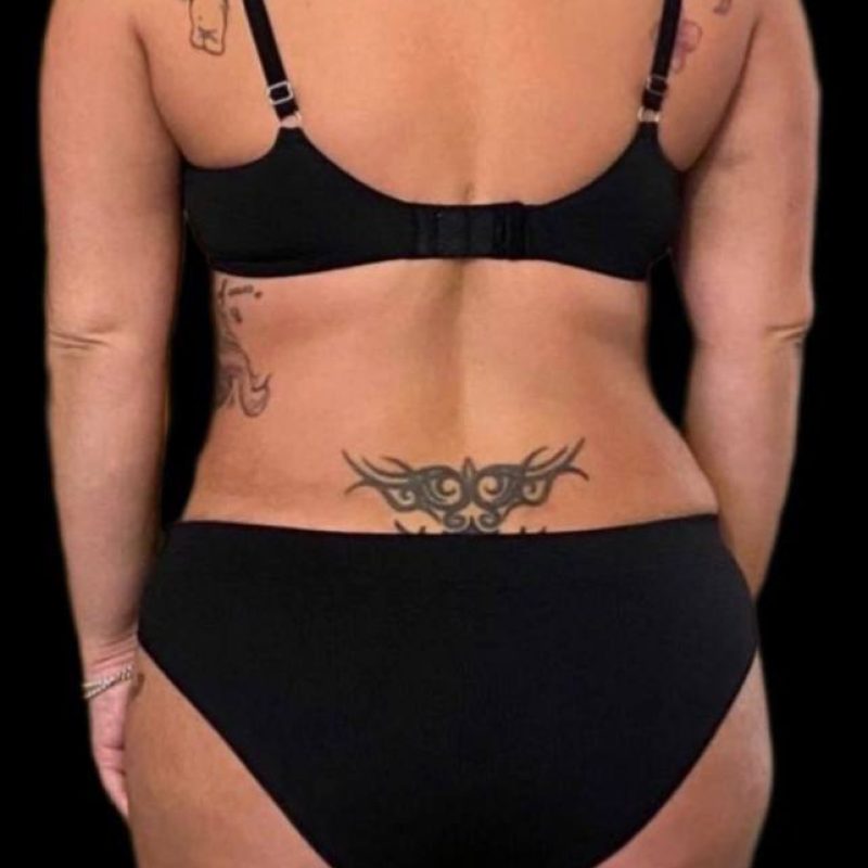 نحت الجسم شفط الدهون 3-2