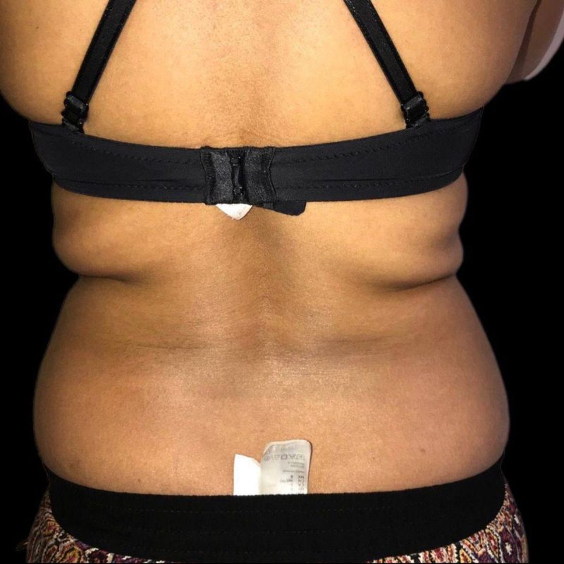 نحت الجسم شفط الدهون 4-1