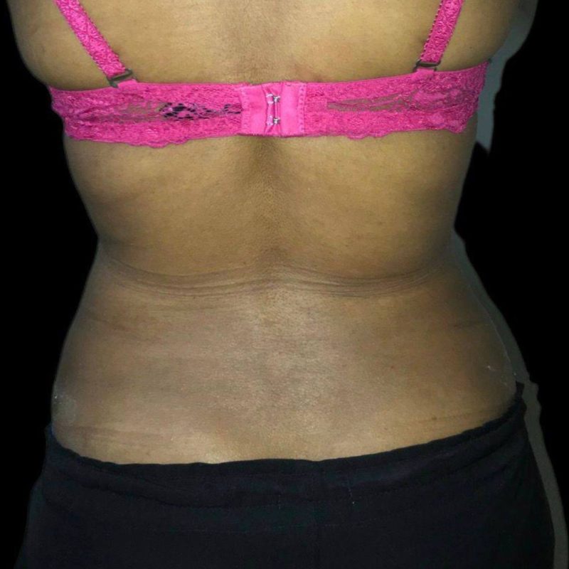 نحت الجسم شفط الدهون 4-2