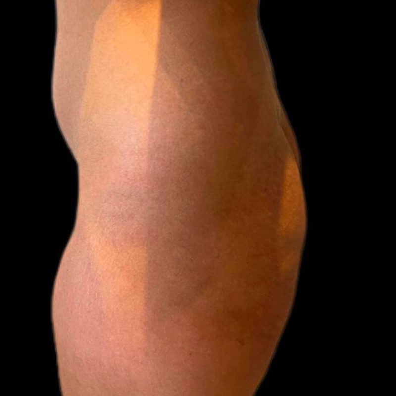 نحت الجسم شفط الدهون 5-1