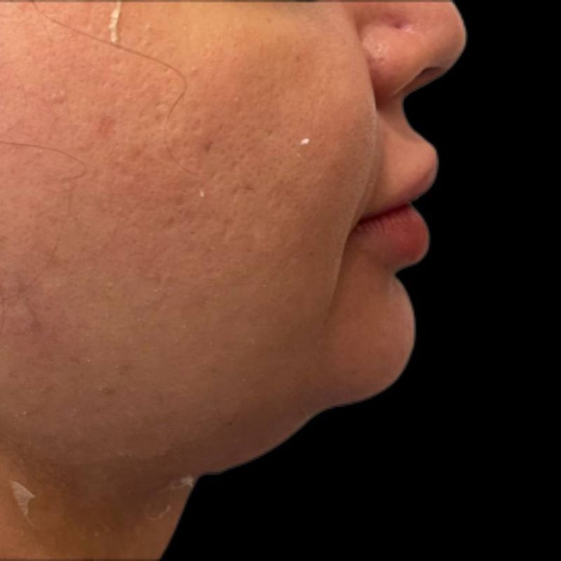 نحت الجسم شفط الدهون 6-1