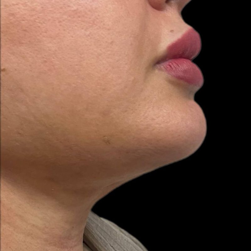 نحت الجسم شفط الدهون 6-2